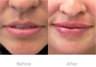Before and after image of lip fillers treatment