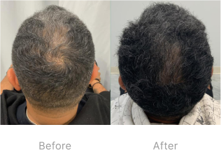 Before and after image of PRP hair loss treatment