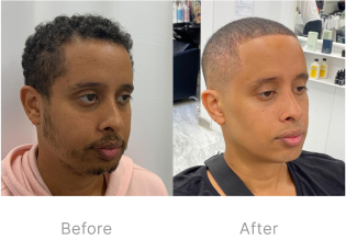 Before and after image of under chin fat melting treatment