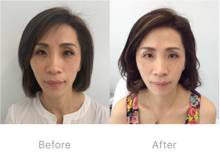 Before and after image of PRP facial treatment