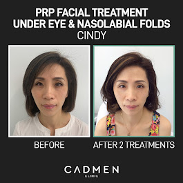 Scalp density before and after a course of PRP at CADMEN Clinic