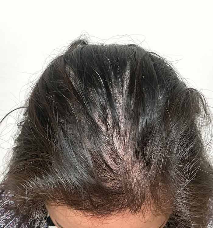 Female 37 after