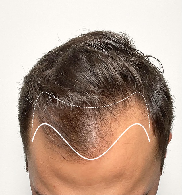 Hairline Thinning