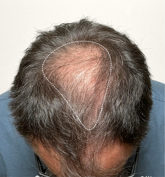 Crown Thinning